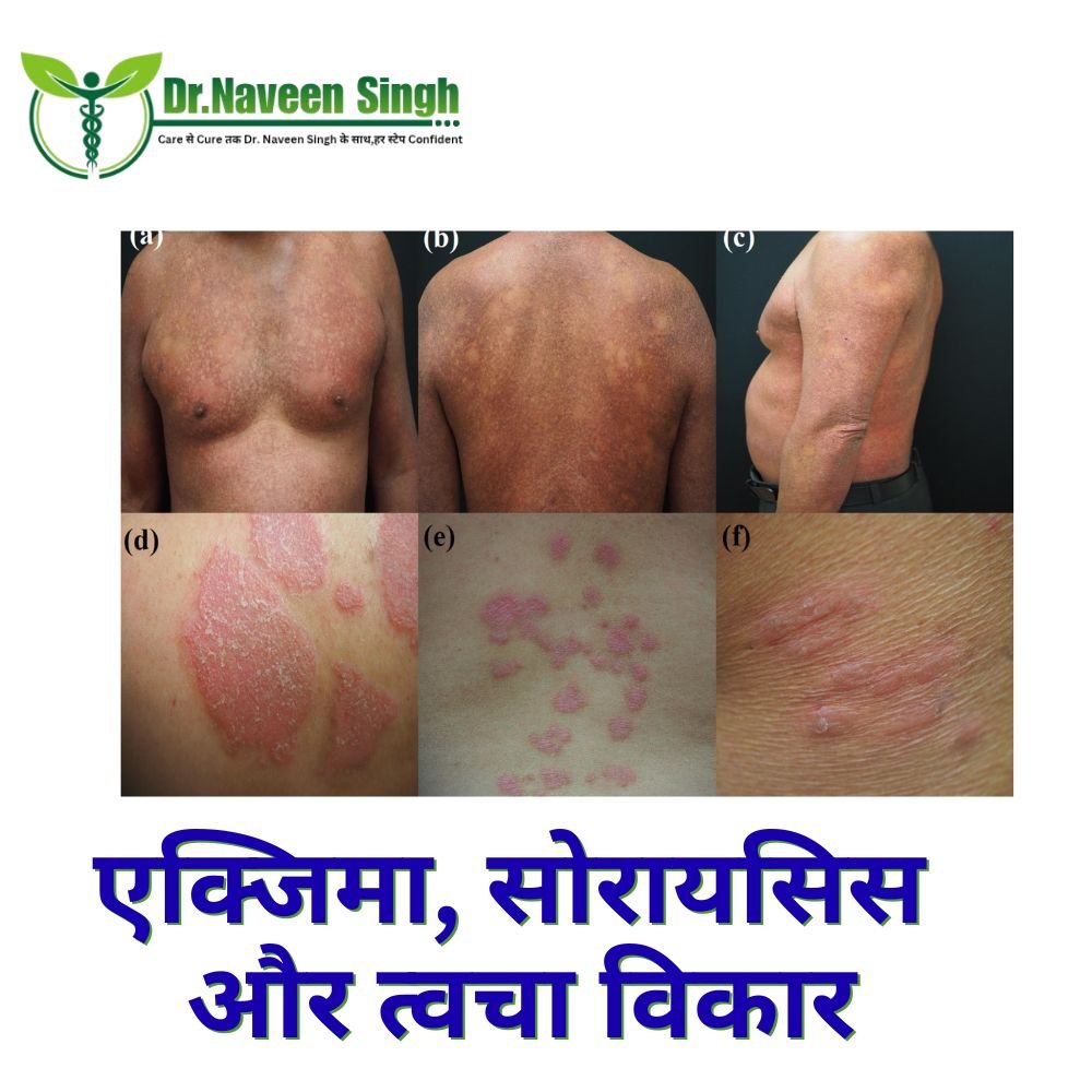 एक्जिमा, सोरायसिस और त्वचा विकार